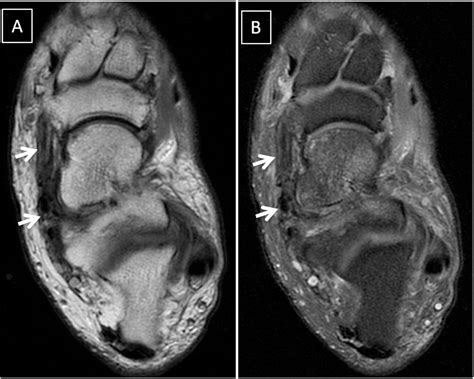 Spring ligament complex: Illustrated normal anatomy and spectrum of pathologies on 3T MR imaging ...