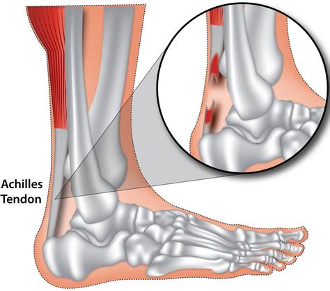 Achilles Tendon Rupture Information and Help SportNova UK - DaftSex HD