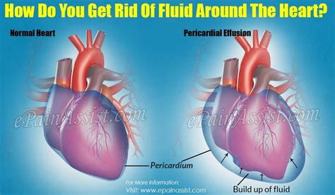 How Do You Get Rid Of Fluid Around The Heart? | Pericardial effusion, Normal heart, Fluid