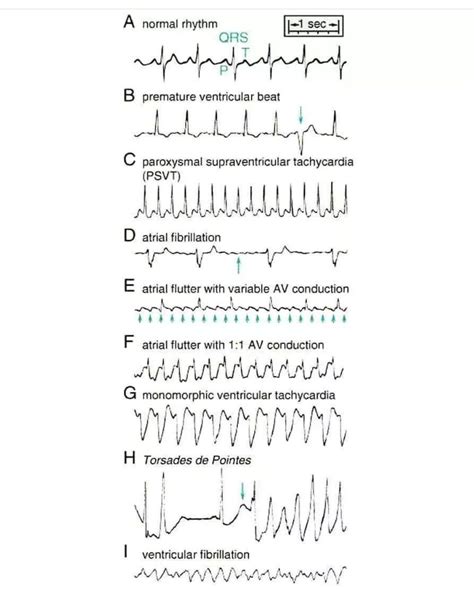 Normal Vs Abnormal Sinus Rhythm - MEDizzy