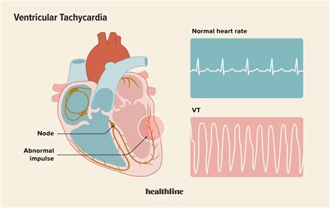 Ventricular Tachycardia: Causes, Symptoms, and Diagnosis