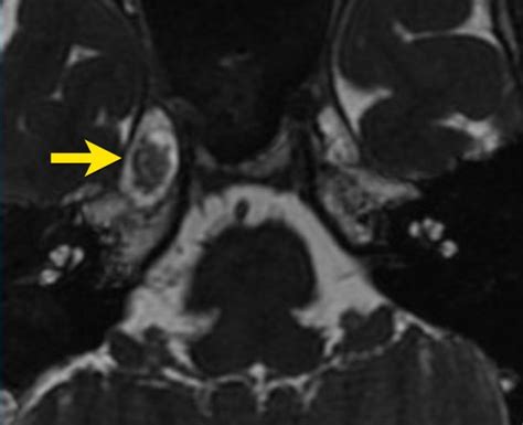 Trigeminal Nerve Mri Sagittal