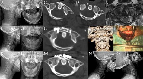 A 32-year-old female with atlas fracture treated by transoral anterior... | Download Scientific ...