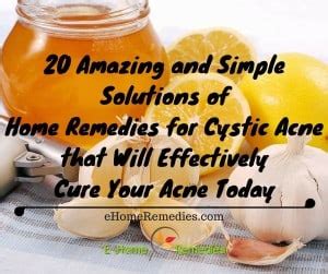 20 Amazing & Simple Home Remedies for Cystic Acne