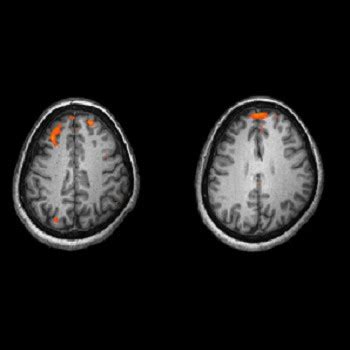 Advanced MRI Scans Could Predict Schizophrenia - HealthManagement.org