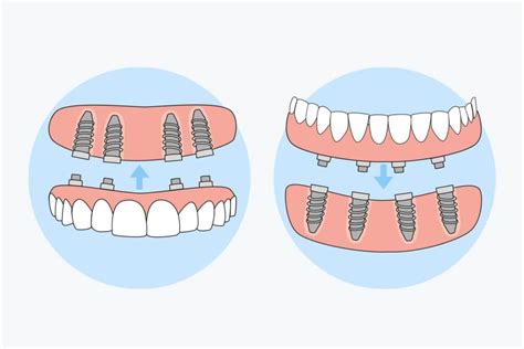 Difference between temporary and permanent dental implants