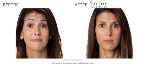 Botox Before and After | Real Patient Results in Chatham