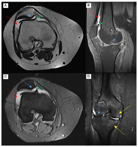 Osteoarthritis Knee Mri