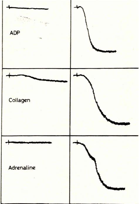 Platelet aggregation curves during and after the haemorrhagic episode ...