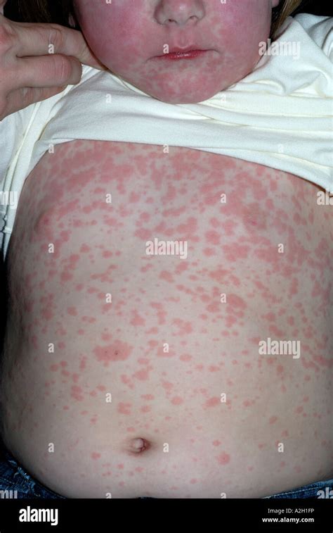 Amoxicillin drug rash on young girl Stock Photo: 10521801 - Alamy