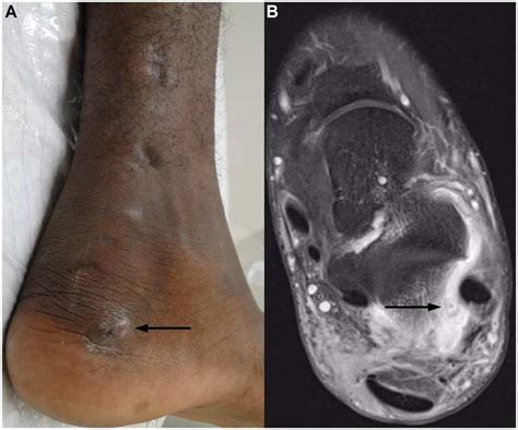 Case 2. (A) Clinical presentation after drainage of the subcutaneous ...