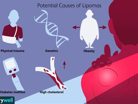 Lipoma Ultrasound Treatment - Infoupdate.org