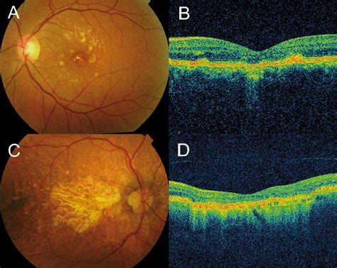 Macular Dystrophy Retina