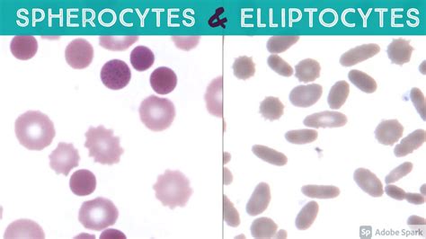 Spherocyte/Spherocytosis, Elliptocyte/Elliptocytosis, Echinocyte (Burr Cell) Peripheral Blood ...