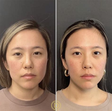 Botox Masseter: Before and After Transformation - BeautyKylie