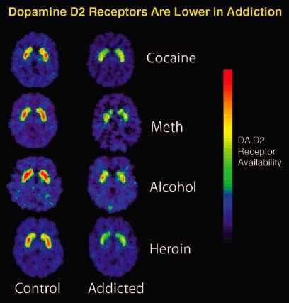 Addiction Brain Scans, Unscrambled | The Fix