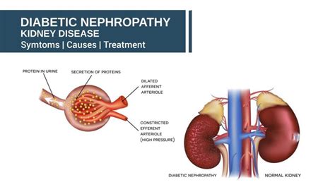 Understanding Diabetic Kidney Disease