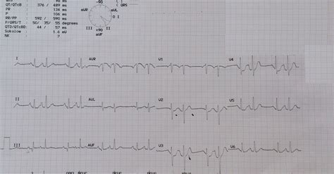 Medical PBL: Case Files 11: My Heart Skipped A Beat - SOLVED