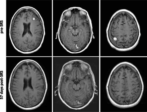 Melanoma brain metastases treated with stereotactic radiosurgery and concurrent pembrolizumab ...