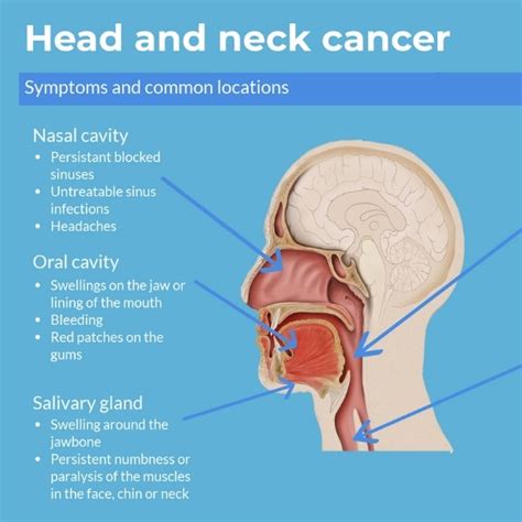 Head And Neck Cancer Diagram