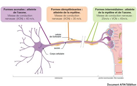 Maladie De Charcot : Maladie De Charcot - Maladie De Charcot Des Causes ... : Amyotrophic ...