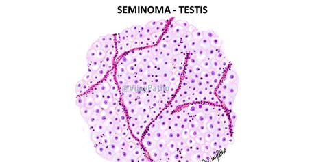 SEMINOMA- TESTIS - Pathology Made Simple