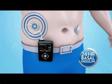 Medtronic 780G Insulin Pump at best price.