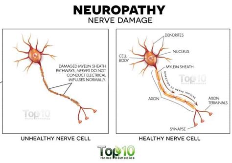 Nerve Damage: Causes, Symptoms, & Possible Complications | Nerve damage ...