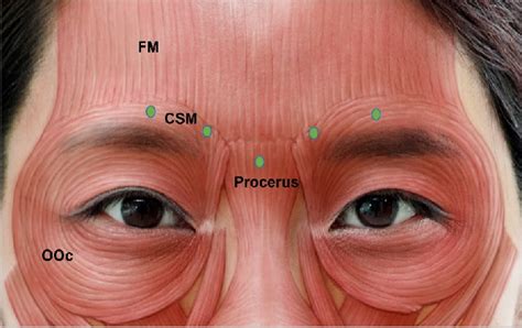 Glabella injection points. FM, frontalis muscle; OOc, orbicularis ...