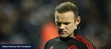 Wayne Rooney Hair Transplant - Smile Hair Clinic