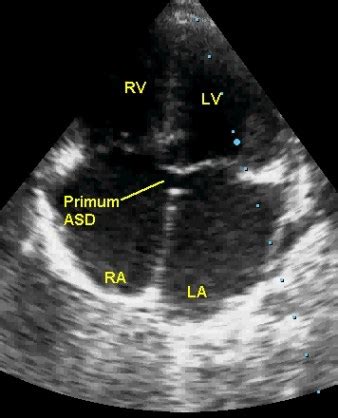 Atrial septal defect (ASD) – All About Cardiovascular System and Disorders