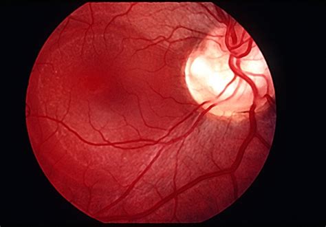 Optic Nerve Pit - Retina Image Bank