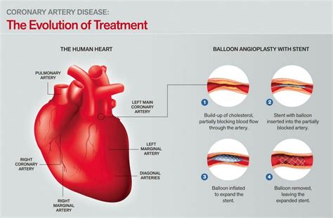 Number Of Diagonal Arteries / Intervention For Jailed Diagonal Branch Is Not Necessary While ...