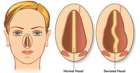 Minimally Invasive Sinus Treatment | NY Allergy & Sinus Centers