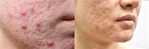 Cystic Acne Scars – What They Are And How To Treat Them