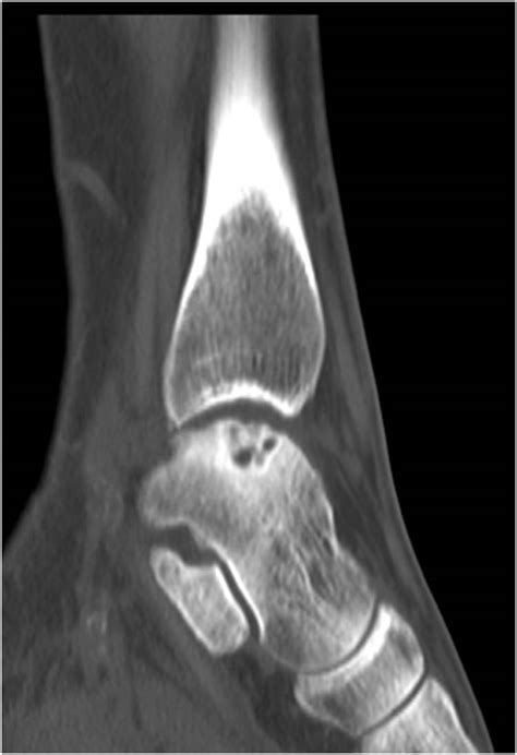 Talar dome lesions | The Foot and Ankle Online Journal