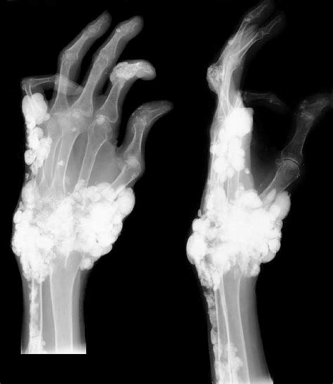 Soft Tissue Calcifications — UW Radiology | Radiology imaging, Radiology, Medical curiosities