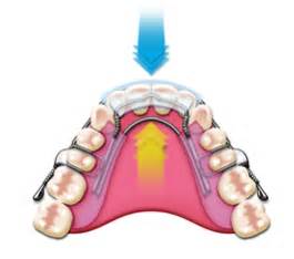 Inman Aligner Weston Super Mare | Teeth Straightening Burnham | Clevedon