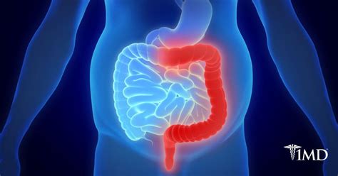 What Is Inflammatory Bowel Disease? | 1MD