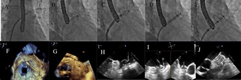 Extending percutaneous left atrial appendage closure indications using the AMPLATZER™ Cardiac ...