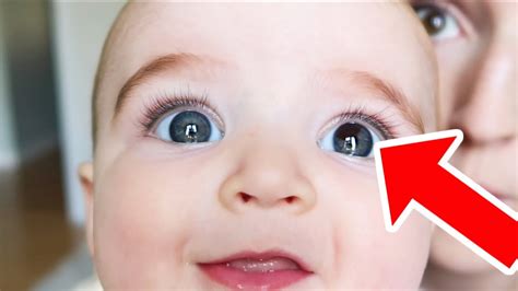 BABY BORN WITH RARE EYE BIRTHMARK! - YouTube