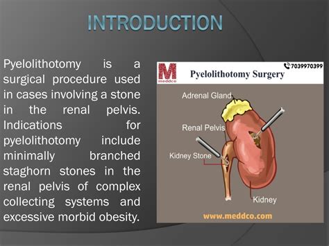 PPT - PYELOLITHOTOMY SURGERY PowerPoint Presentation, free download - ID:11317545