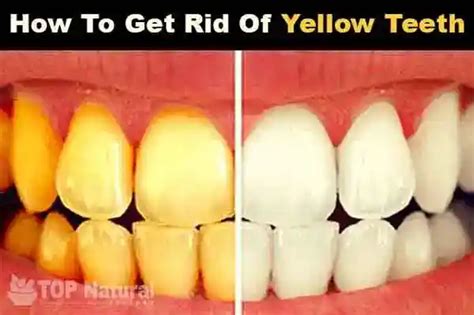 7 Home Remedies for Whitening Yellow Teeth – Top Natural Recipes