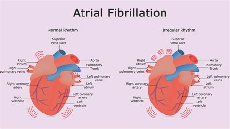 slsi.lk - how long for sulfatrim to work | Can medications cause irregular heartbeat consider, that