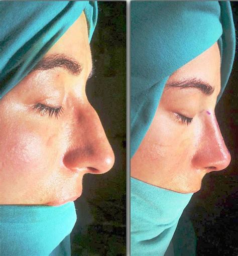 Nose job, Perfect nose, Rhinoplasty