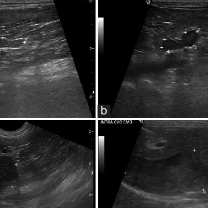 (a) Ultrasound images of the adrenal glands showing the appearances... | Download Scientific Diagram