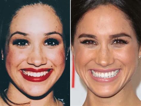 Meghan Markle, Before and After | Meghan markle, Celebrity surgery ...