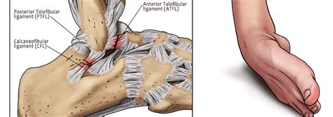 Return to Sports After an Ankle Sprain