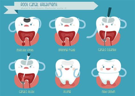 Your Guide To A Root Canal - Eagle Rock Dental Care