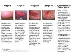 Figure B depicts the NPUAP pressure ulcer stages I - IV with ...